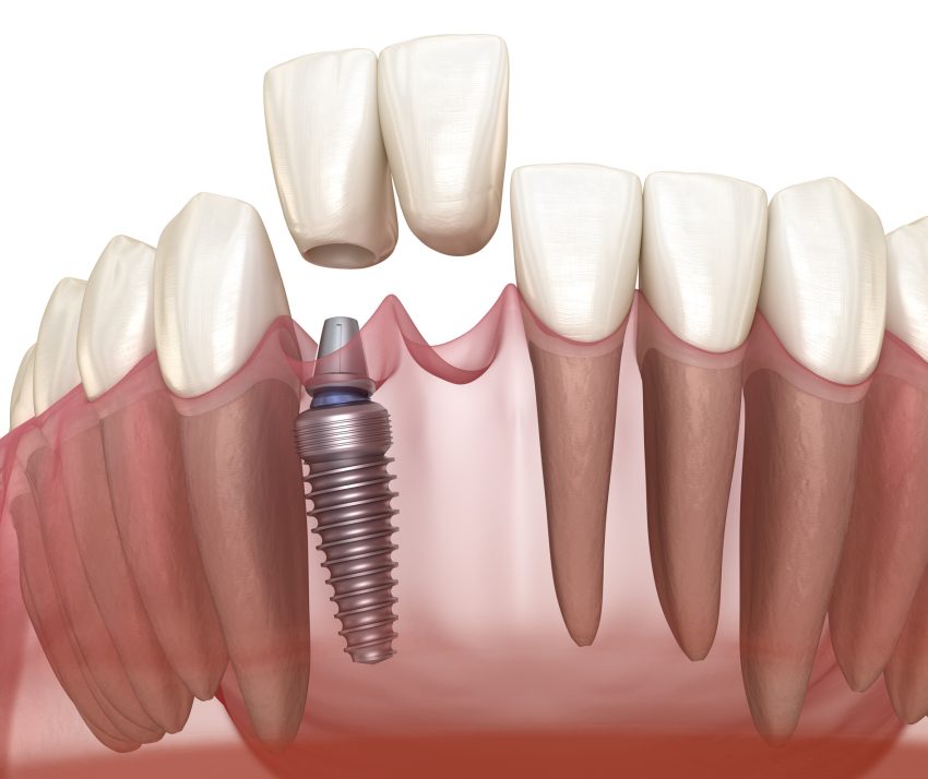 The Lifespan and Care of Dental Implants in Melbourne